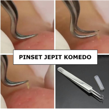 Alat Capit Untuk Menghilangkan Komedo / Penjepit Komedo / Pinset Jepit Komedo Stainless Steel Blackh