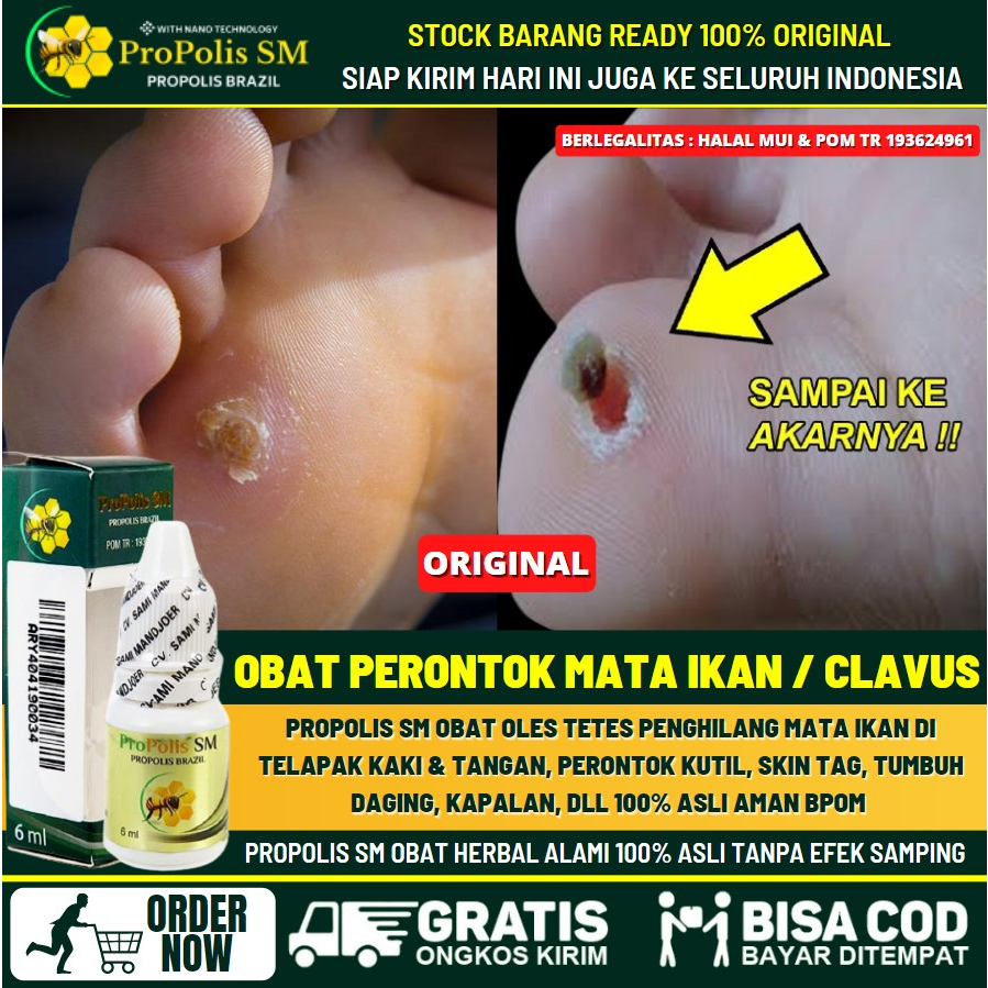 OBAT MATA IKAN OLES - PENGHILANG MATA IKAN DI TELAPAK TANGAN & TELAPAK KAKI - SALEP CAIR RONTOKKAN M