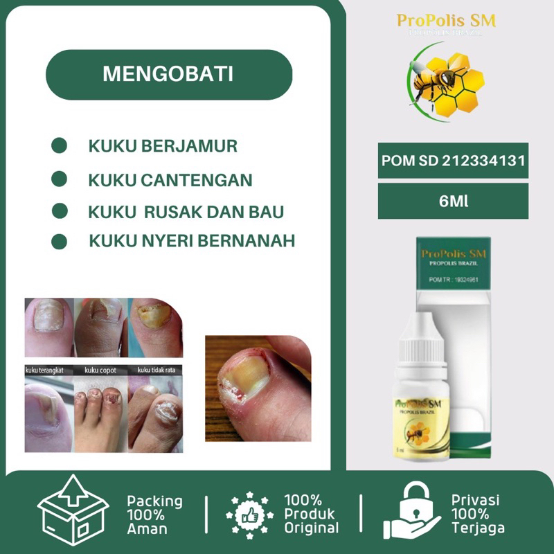 Obat Kuku Jamur, Onikomikosis, Infeksi Jamur Kuku, Obat Kuku Rusak Busuk Berjamur Infeksi kuku Jempo