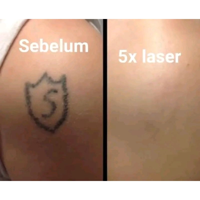 

Mesin penghapus tatto