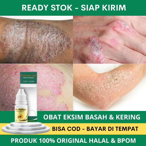 Obat Eksim, Obat Eksim Kering, Obat Eksim Basah, Obat Eksim Kering Menahun, Obat Penyakit Eksim, Oba