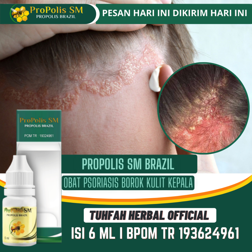 Obat Psoriasis Kulit Kepala, Obat Gatal Kulit Kepala, Obat Koreng Kepala, Obat Ketombe Kerak Kulit K