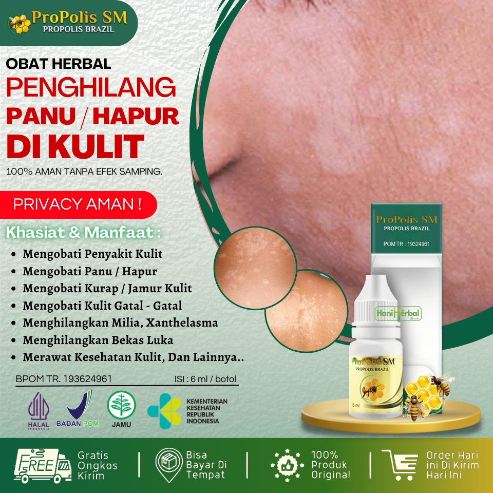 Obat Panu Herbal Alami / Obat Panu Cair / Obat Panu Untuk Anak dan Dewasa / Penghilang Panu / Hapura