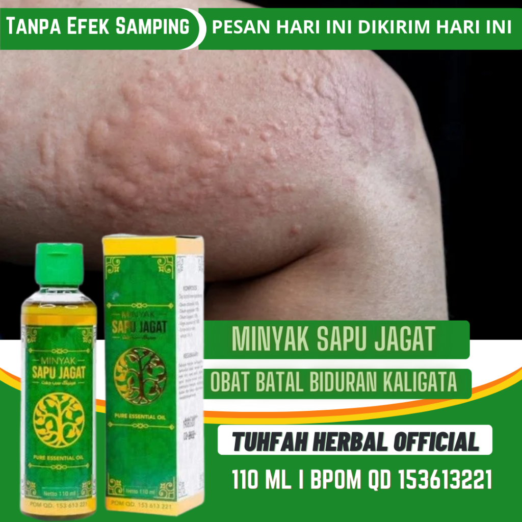 Obat Biduran, Kaligata, Gatal Gatal, Biduran Menahun, Kaligata Menahun, Alergi Dingin, Biduran di Se