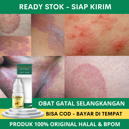 Obat Tetes Gatal Selangkangan - Obat Infeksi Jamur Selangkangan - Obat Pembersih Jamur di Selangkang