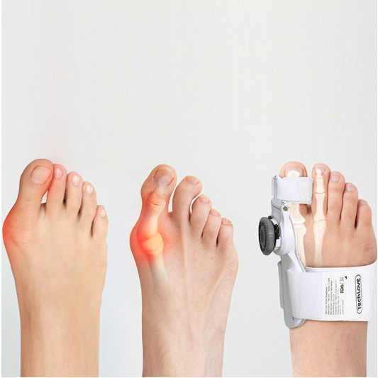 ALAT KOREKTOR PELURUS PENYANGGA TULANG JEMPOL JARI KAKI BUNION HALLUS VALGUS - Splint Big Toe Straightener Corrector Adjustable Knob