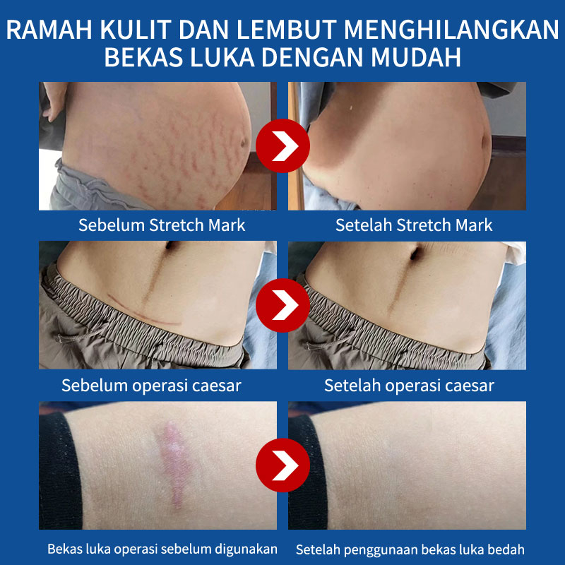 Gel menghilangkan bekas luka krim memudarkan bekas luka memperbaiki jerawat bekas luka lama bekas luka stretch mark bekas luka bakar 20g