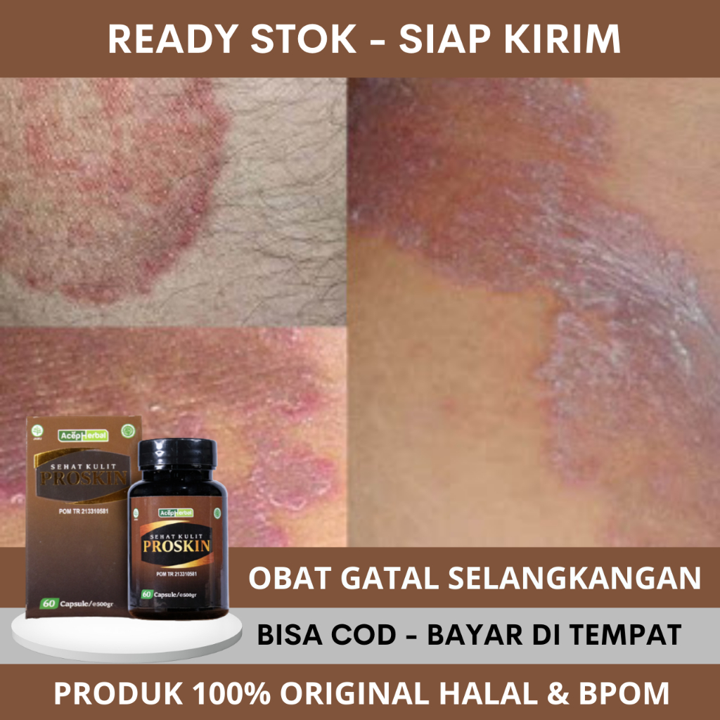 Obat Masalah Kulit Gatal Di Selangkangan Pria Wanita - Obat Gatal Selangkangan - Obat Gatal Selangka
