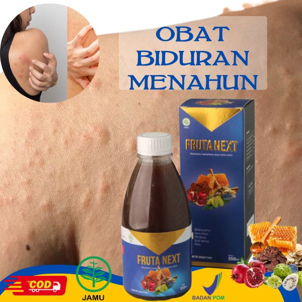Cara Mengobati Biduran Agar tidak Kambuh Lagi Obat Biduran Menahun Herbal FrutaNext Aman