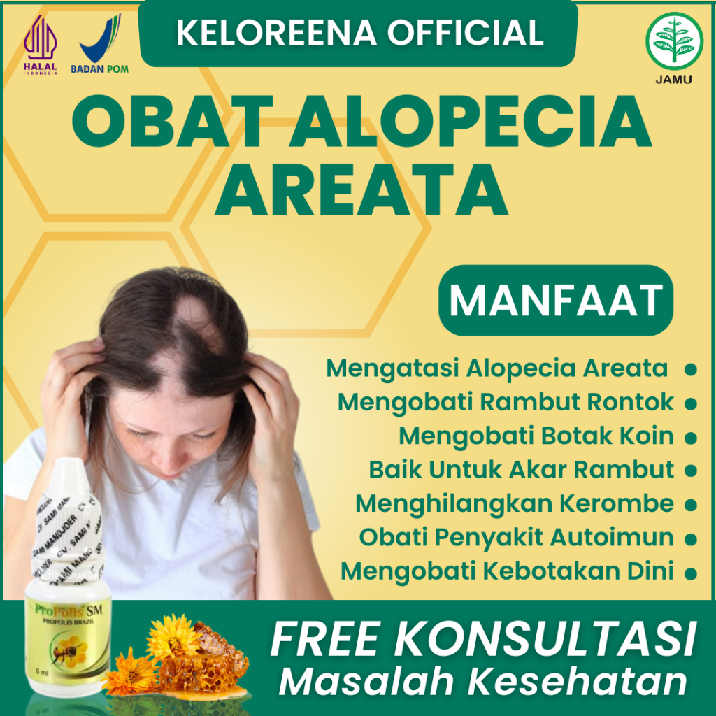 Obat Alopecia Areata Pencegah Kerontokan Rambut Parah Kebotakan Pada Kepala Rontok Penyakit Autoimun