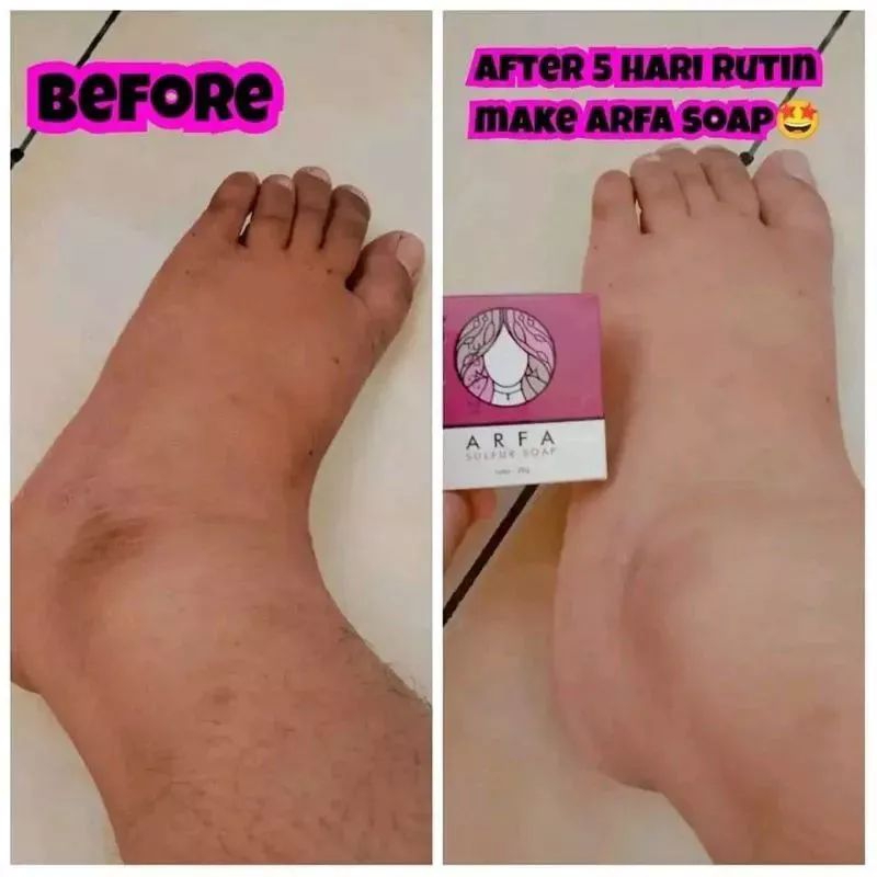 ARFA SULFUR SOAP / SABUN ARFA SULFUR