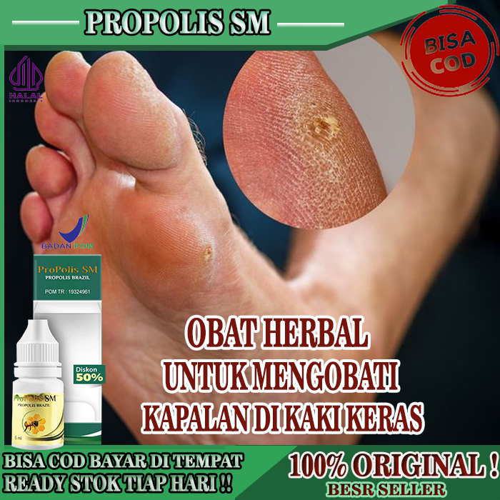 Obat Untuk Kaki Kapalan Kulit Menebal Kering, Obat Penghilang Kapalan Kulit Kering Pecah - Pecah, Ob