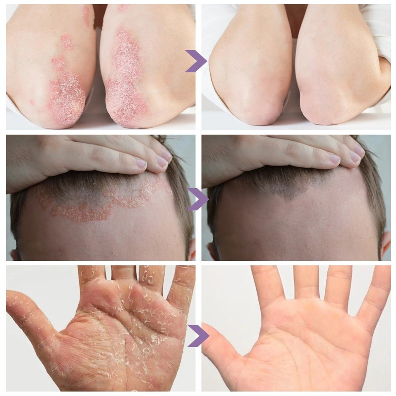 salep gatal gatal obat gatal gatal psoriasis 30g Salep Dermatologis Antijamur yang Menenangkan Dermatitis Psoriasis Eksim Krim Pereda Gatal