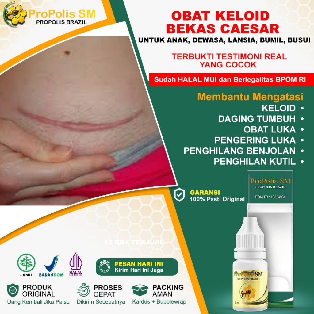 Obat Keloid Bekas Operasi Obat Keloid Daging Jadi Obat Keloid Di Dada Obat Penghilang Keloid Obat Ke