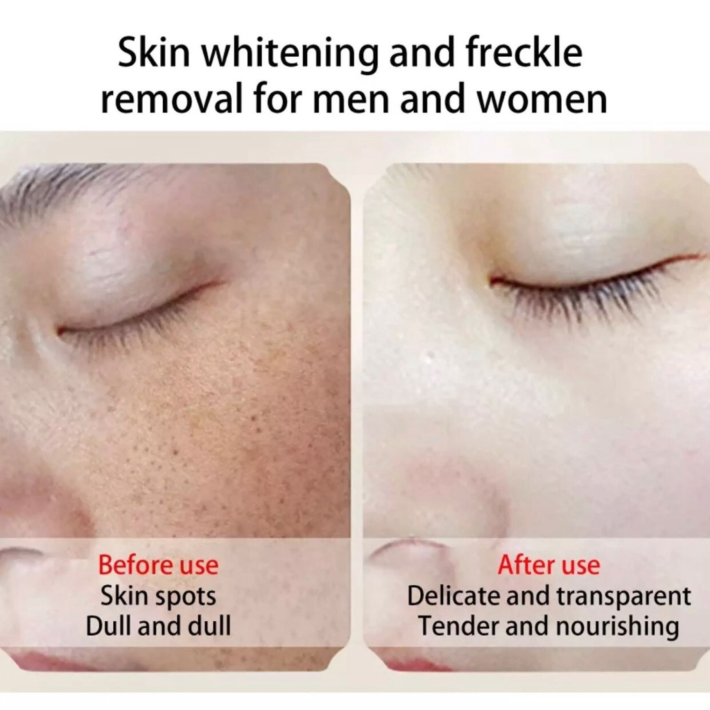 Cindynal Salep Pemutih Krim Flek Hitam Membandel Menghilangkan Melasma Jerawat Tempat Melanin Bintik-Bintik Efektif Glowing