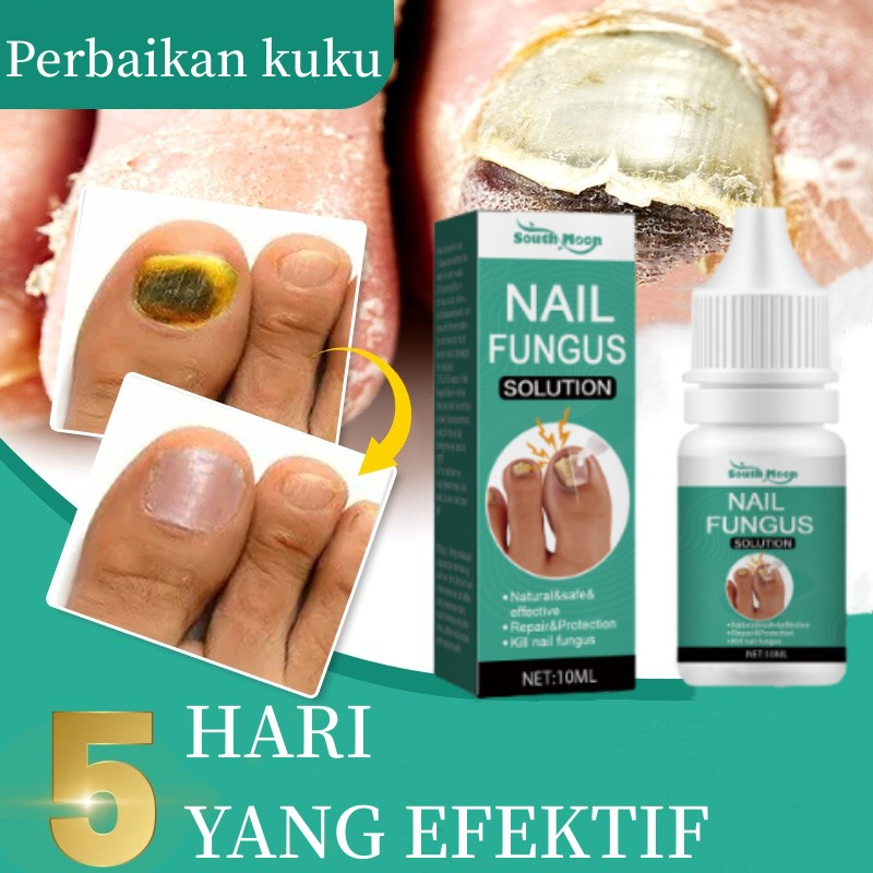obat Jamur Kuku Perawatan Kuku Berjamur Obat Jamur Kuku Paling Ampuh Perawatan Jamur Kuku Cepat Nail