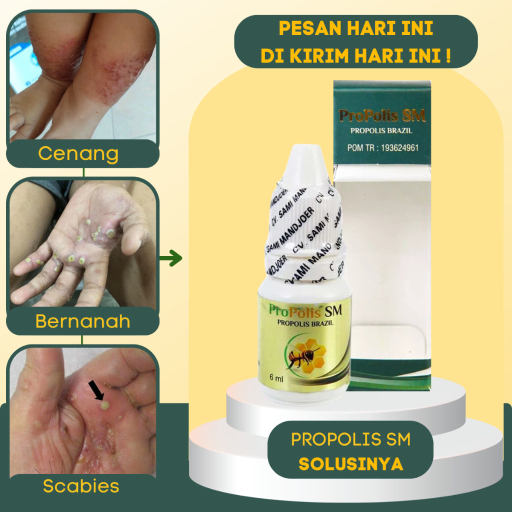 Obat Oles Salep Budug Borok Gatal Bernanah, Obat Budug Di Kaki Dan Tangan, Obat Scabies Manusia Untu