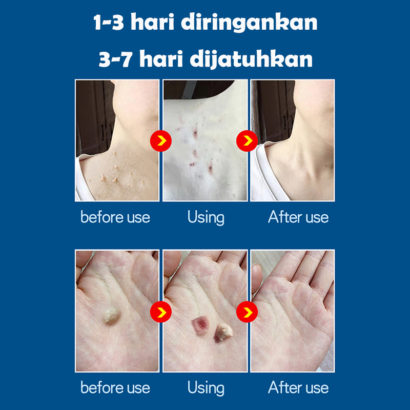 Krim kutil obat penghilang kutil penghilang kutil 20g skin tag remover Menghilangkan kutil, tahi lalat, berbagai skin tag di berbagai bagian tubuh