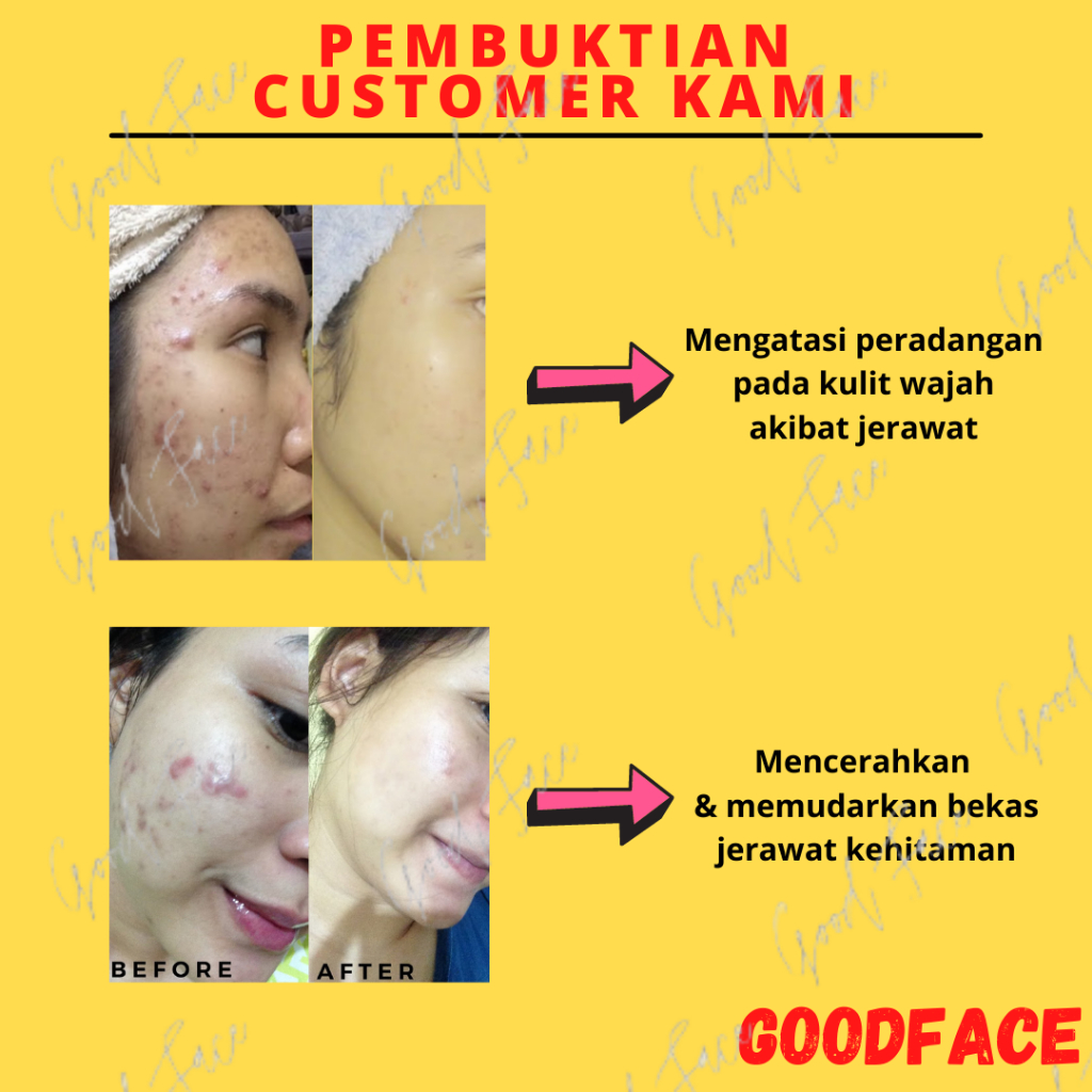 Penghilang Bekas Jerawat BREYLEE Acne Cream Scar Removal Penghilang Noda Bekas Jerawat, Luka &amp; Stretch Mark (30 g)