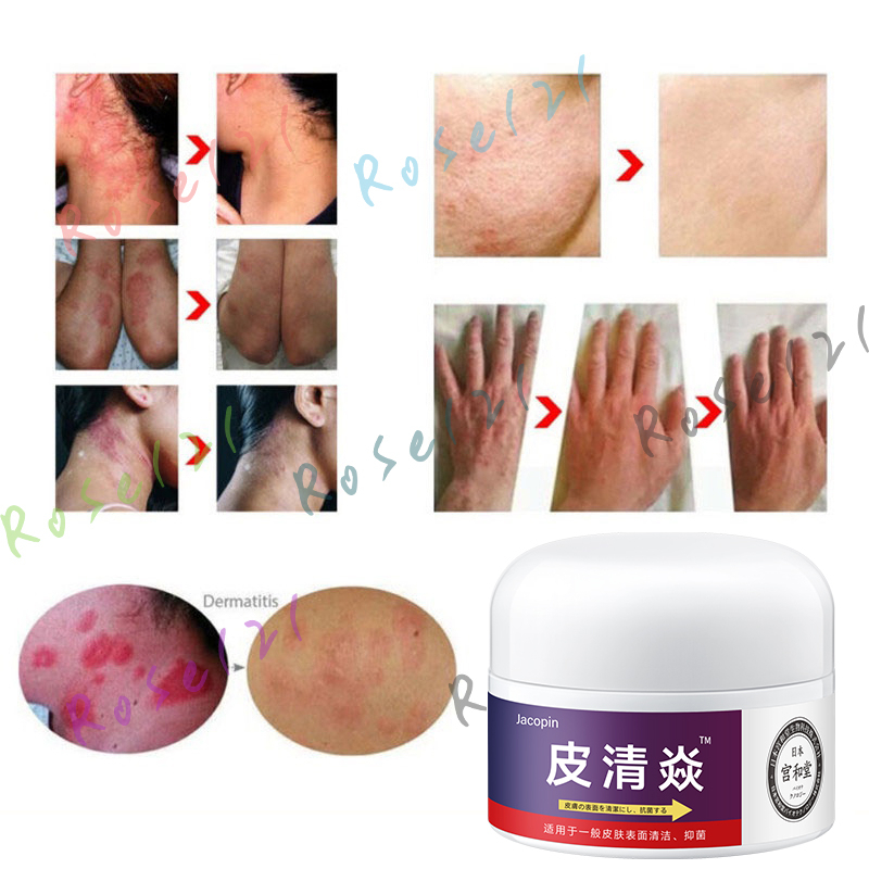 100% Original Psoriasis Eksim Jamur Kurap Alergi Kulit Cream Salep Herbal Cina Anti Bakteri Untuk Semua Jenis Kulit