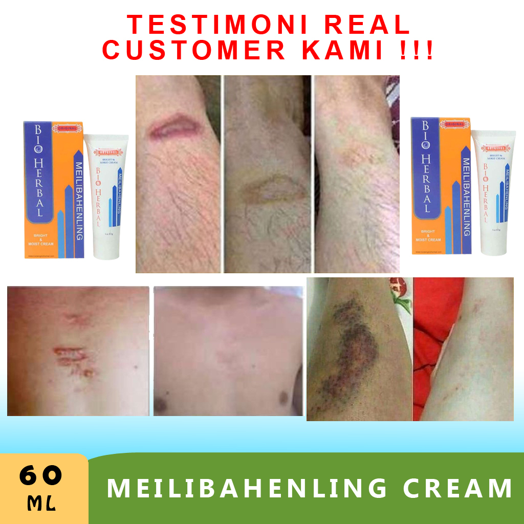 Salep Penghilang Bekas Luka Hitam Jerawat Koreng dan Keloid Cream Krim Penghilang Bekas Luka