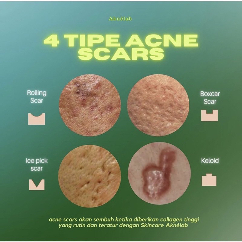 Rangkaian Bekas Jerawat &amp; Acne Scars Series Aknèlab (menghilangkan PIE PIH dan Bopeng sekaligus)