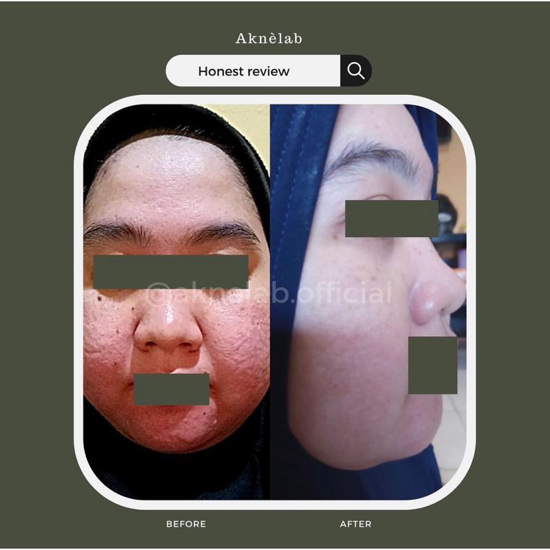 Rangkaian Bekas Jerawat &amp; Acne Scars Series Aknèlab (menghilangkan PIE PIH dan Bopeng sekaligus)