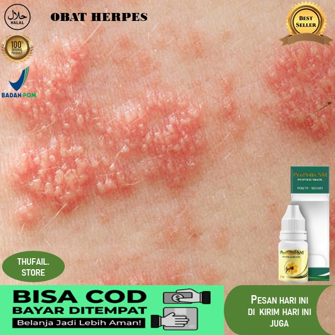 obat herpes obat herpes kelamin  obat herpes genital  Obat Herpes Kulit Pada Bayi Anak Dewasa Herpes