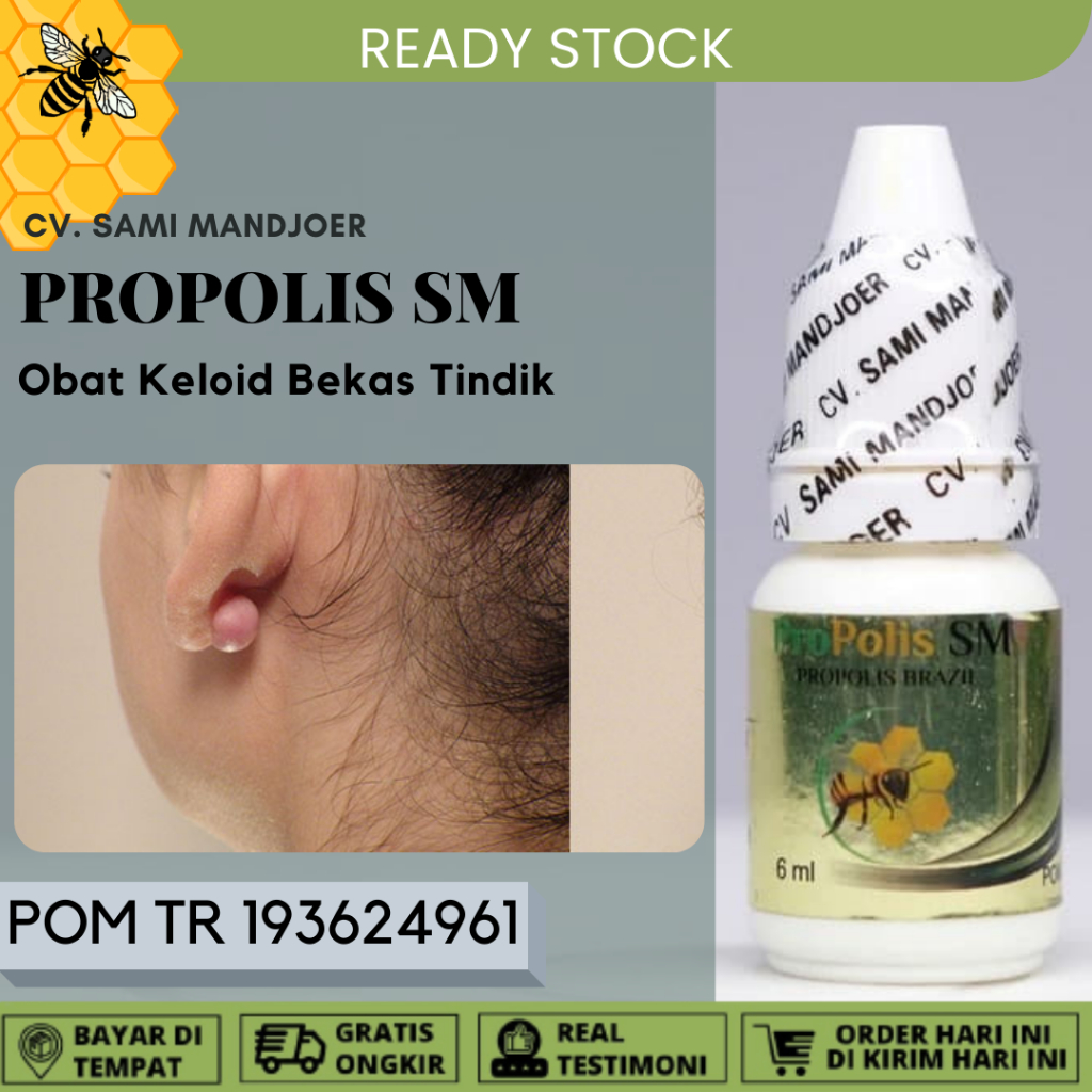 Obat keloid, Obat Keloid Luka Tindik, Penghilang keloid Daging Tumbuh, Obat Kutil Papiloma, Skin Tag