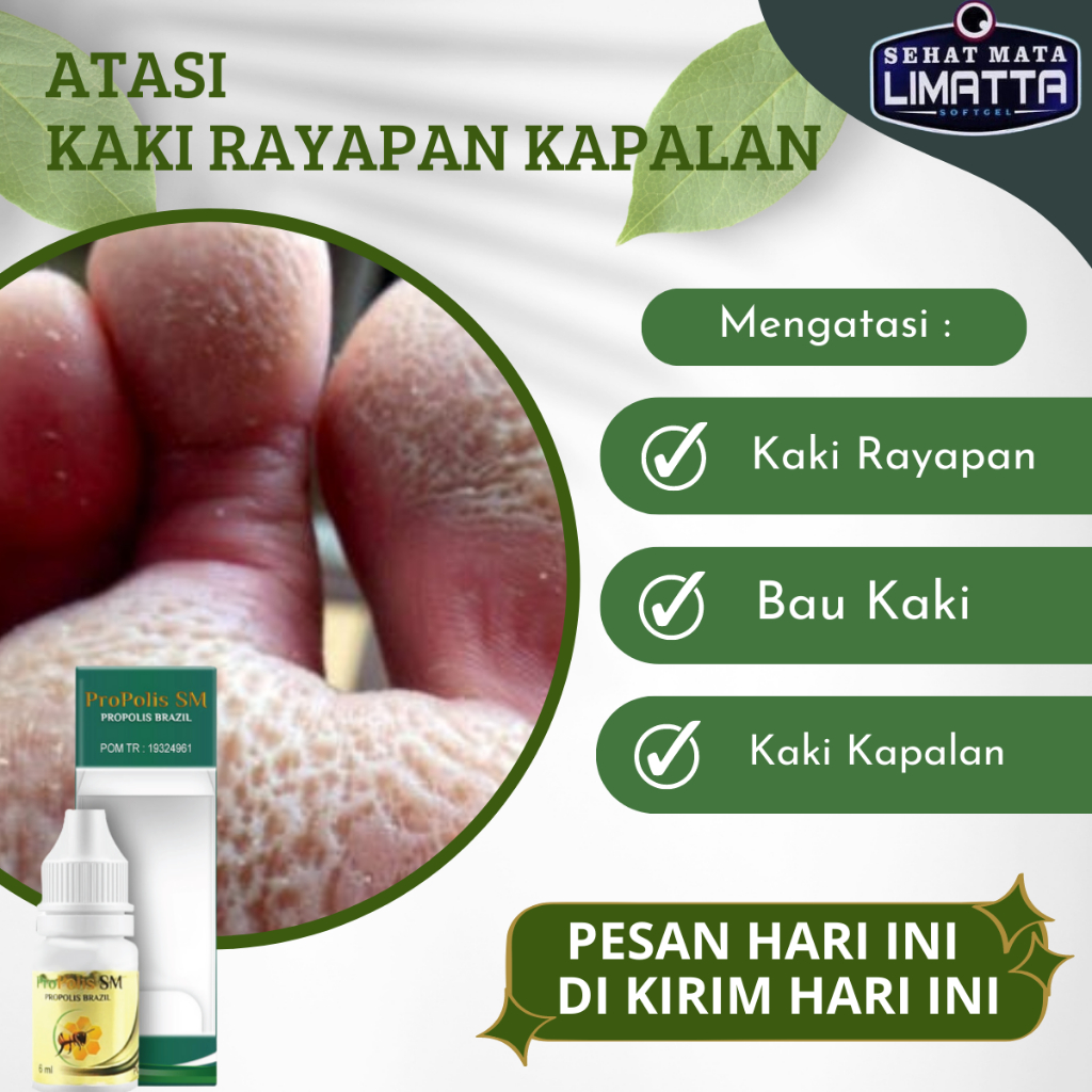 Propolis SM - Obat Kaki Rapayan Bolong Bolong, Obat tetes Kaki Bolong-Bolong dan Bau Kutu Air Roromb