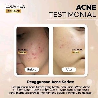 Louvrea facial wash acne/sabun jerawat