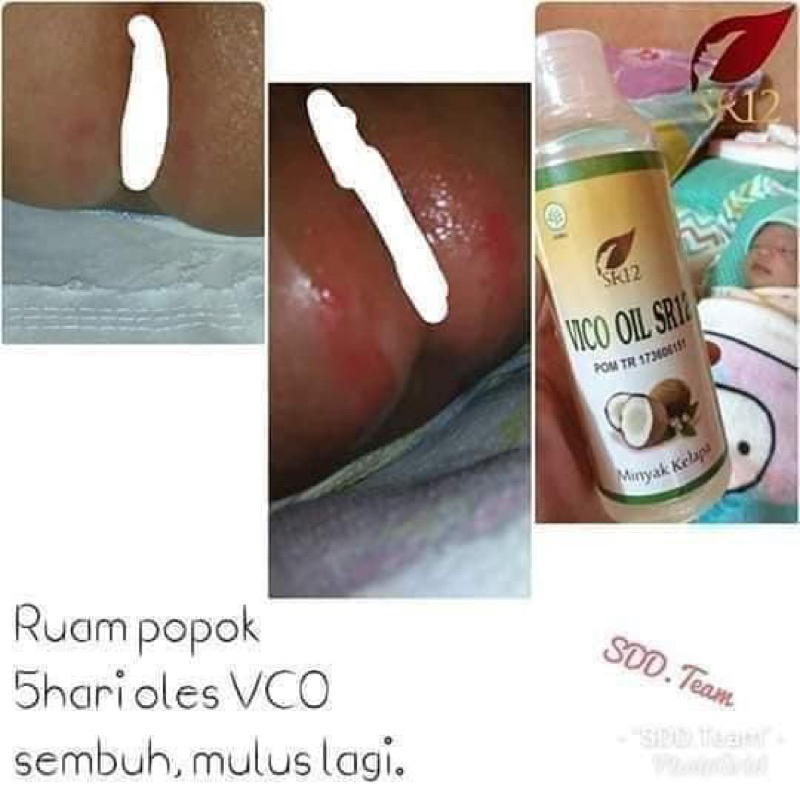 MINYAK KELAPA ASLI , VCO OIL , VCO SR12 , MENGATASI CRADLE CRAP PADA BAYI , OBAT ALERGI BAYI , MINYAK URUT BAYI