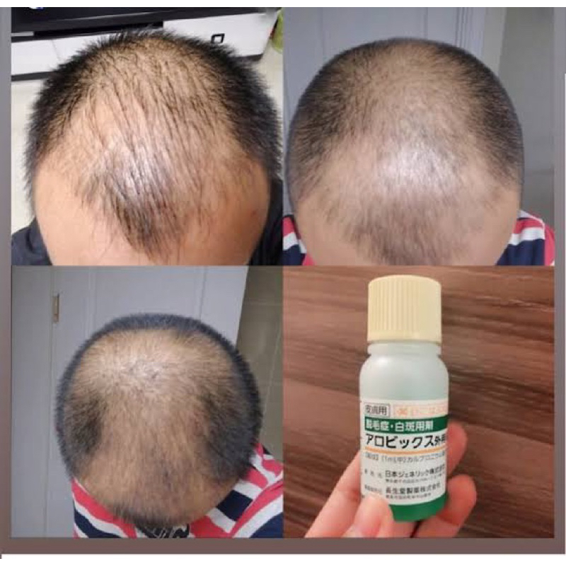 SERUM PENUMBUH RAMBUT DAN ANTI RONTOK JEPANG MENUMBUHKAN JUGA MELEBATKAN EFEKTIF DAN PASTI BERHASIL SERUM ALOPECIA SERUM SEBORRHEA