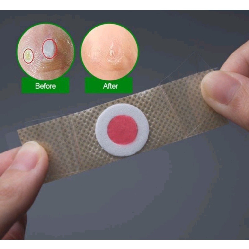 PLESTER KAPALAN MATA IKAN LENGKET TERBUKTI HILANG