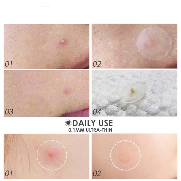 Super Plester Jerawat Acne Patch / Acne Treatment 36 Pcs pagi or Malam Spot Acne Pimple Patch Ultra Thin Transparant_Cerianti