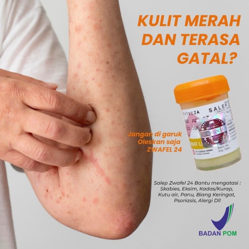 Salep Gatal Zwafel 24 Original 100% Obat Saleb Gatal Panu Kadas Kurap Kutu Air