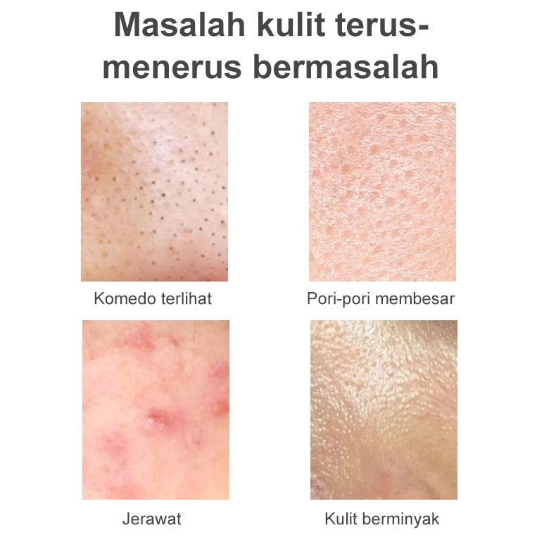 Acne Cream Krim Jerawat Azelaic Acid Cleansing Gel 30ml  Jerawat untuk Menyembuhkan dan Mengempeskan Jerawat | Acne Spot | Night Day Cream | Essence | Skincare Skin