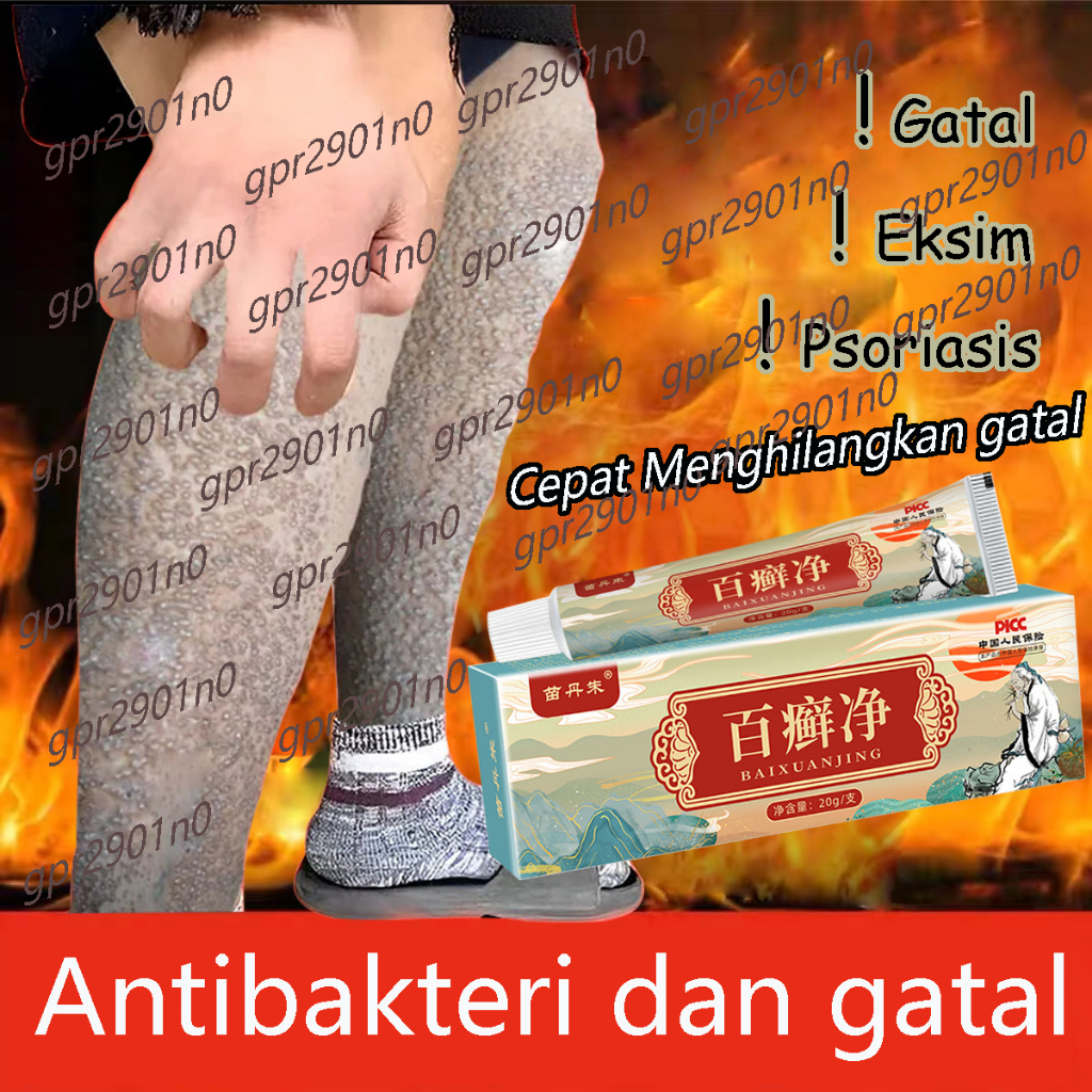 SALEP KULIT EKSIM SALEP OBAT GATAL ASLI 100% ATASI EKSIM PANU Krim Pengobatan Eksim, Krim Herbal Psoriasis, Krim Eksim