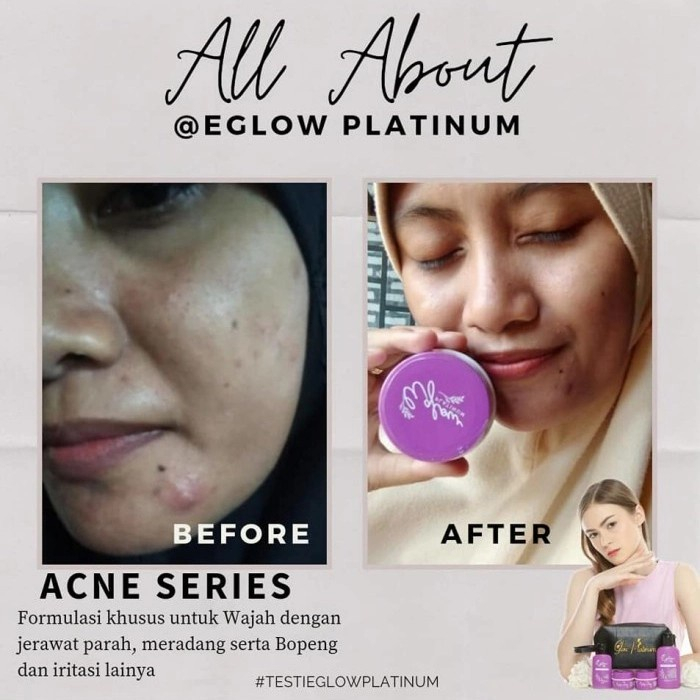 BPOM ORI | Paket Kecantikan By Eglow | Whitening | Acne | Ultimate
