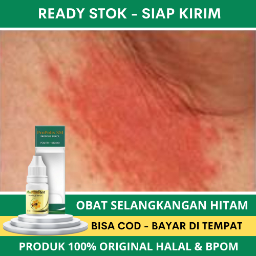 Obat Selangkangan Hitam, Obat Gatal Selangkangan, Obat Penghilang Gatal Selangkangan, Obat Selangkan