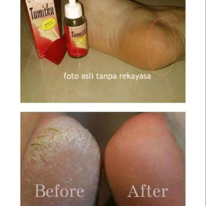 TUMITKU 30ml OBAT KAKI PECAH KAPALAN BPOM