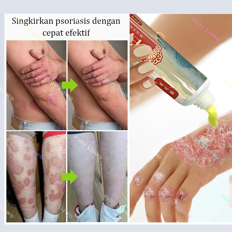 Obat Gatal Salep gatal Salep eksim Obat psoriasis Salep psoriasis 20G 【100% Original】Salep Kulit Jamur Dermatitis Psoriasis Eksim Jamur Kurap Alergi Kulit Cream Obat Gatal
