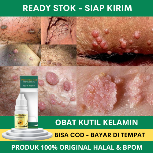 Obat Kutil Kelamin HPV, Obat Kutil Di Anus, Obat Kutil Kelamin Pria, Obat Kutil Kelamin Wanita, Sale