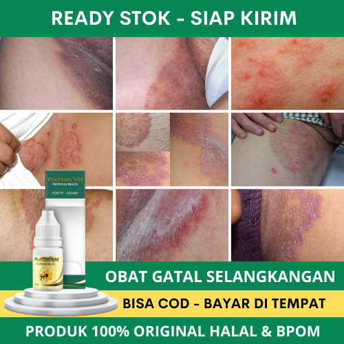 Obat Selangkangan Hitam, Obat Gatal Selangkangan, Salep Gatal Selangkangan, Obat Penghilang Gatal Se