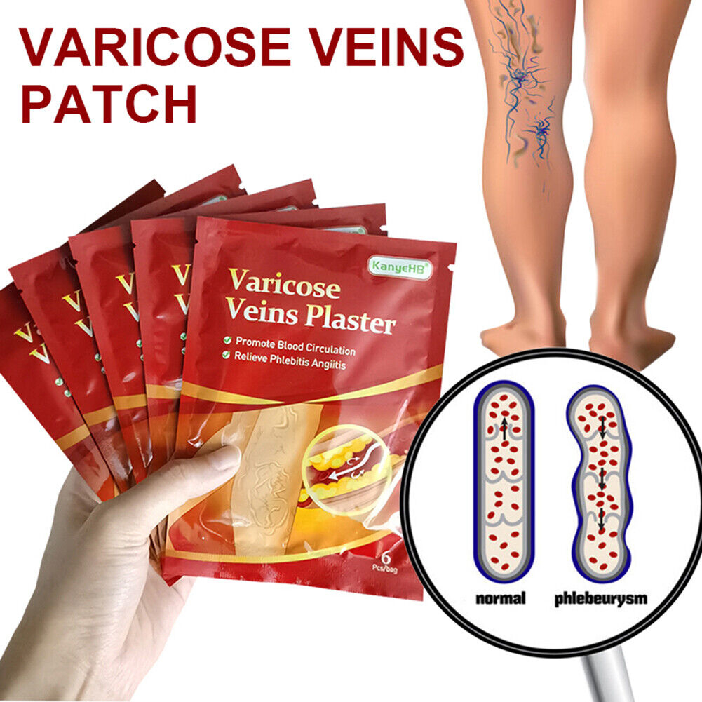 Koyo Penghilang Varises Paling Ampuh Varicose Veins Plaster Original 1pack Isi 6pcs