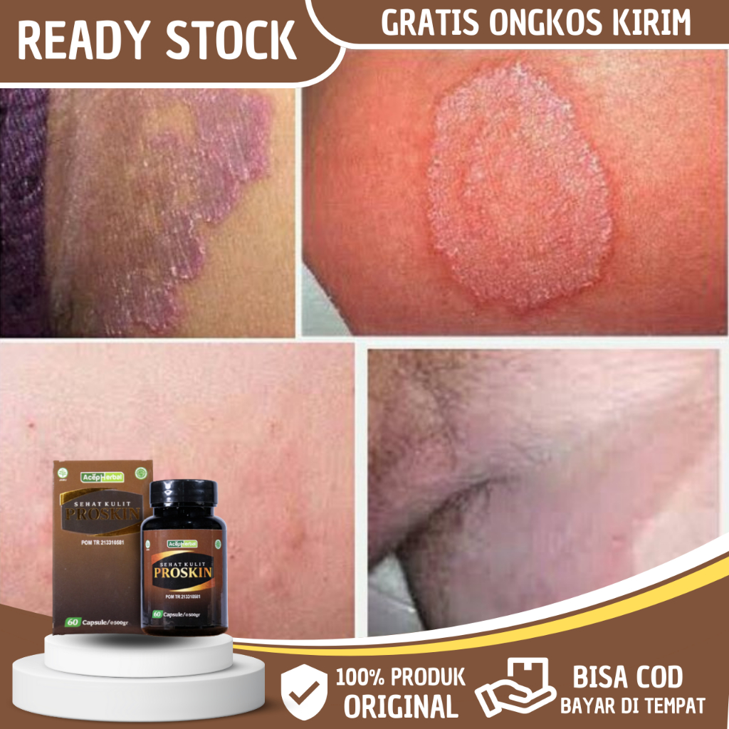 Obat Gatal Selangkangan, Obat Selangkangan Menghitam dan Gatal, Obat Infeksi Jamur Selangkangan, Oba
