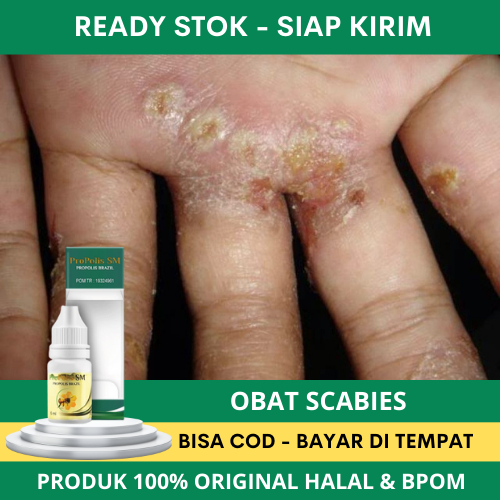 Obat Penghilang Scabies, Penghilang Scabies, Penghilang Bekas Scabies, Obat Gatal Scabies Paling Mur