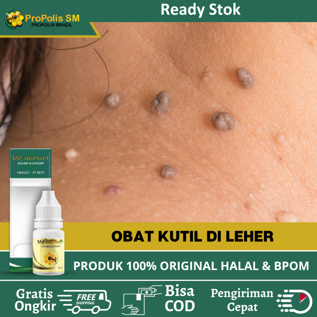 Obat Kutil di Leher, Obat Perontok Kutil Di Leher, Obat Kutil, Obat Penghilang Skin Tag, Obat Papilo