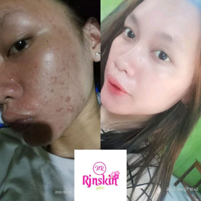BPOM NRGLOW RJNSKIN SKINCARE PALING AMPUH MEMUTIHKAN 7HARI