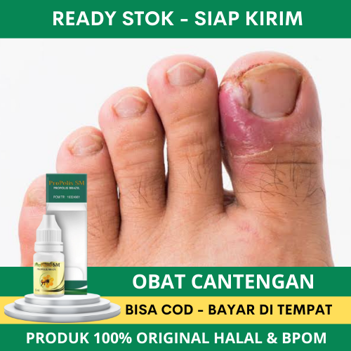 Obat Cantengan, Obat Cantengan Jempol Kaki, Obat Cantengan Tangan, Solusi Kaki Cantengan, Obat Kuku 